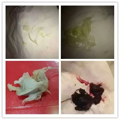 使用花清丹后排出的子宫垃圾